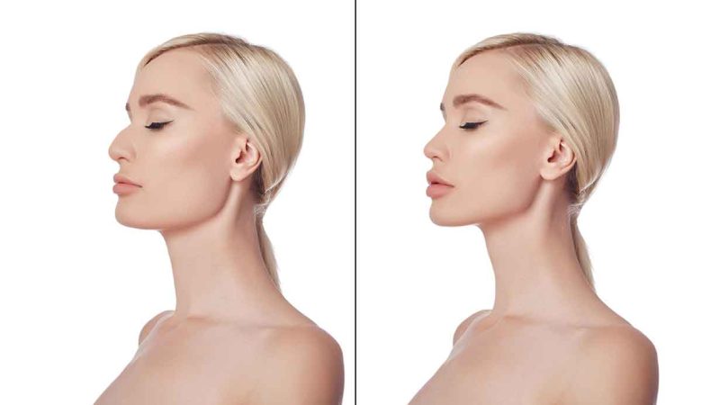 Rhinoplasty Recovery Timeline: From Beginning To End